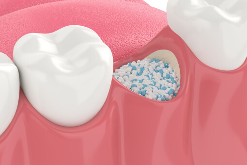 Bone Grafting