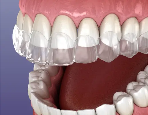 Clear Aligners in San Luis Obispo, CA