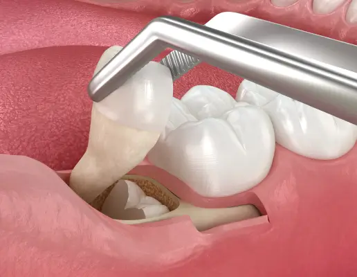 Wisdom Teeth Removal in San Luis Obispo, CA