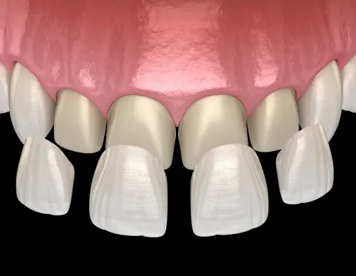 Dental Veneers in San Luis Obispo, CA
