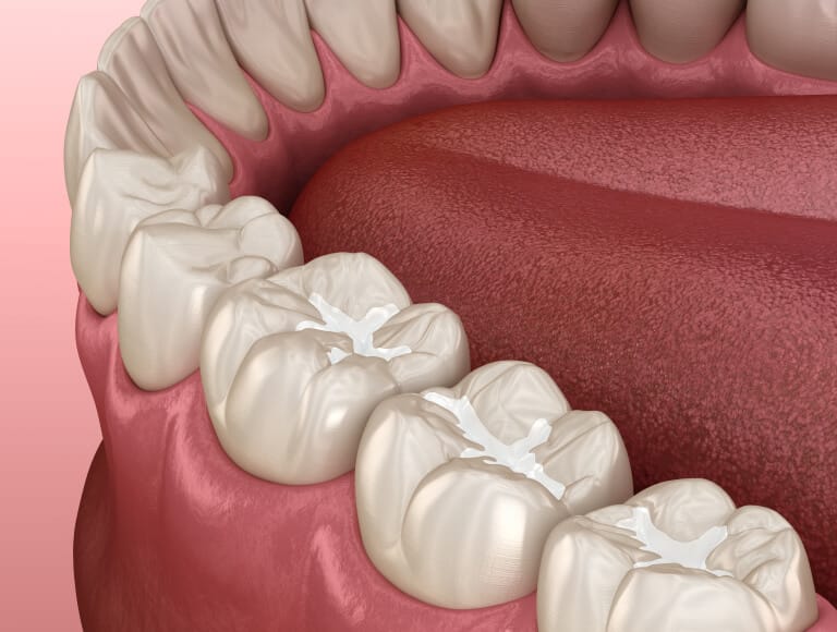 Are Dental Sealants Right for You?