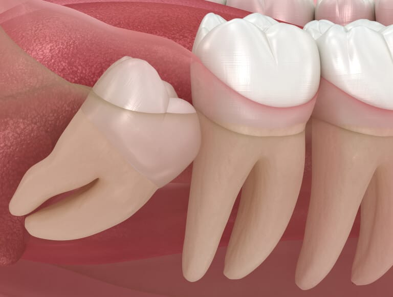 Wisdom Teeth Removal